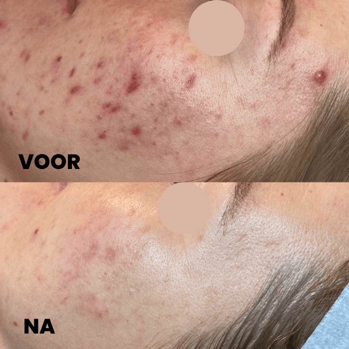 Resultaat van het Acnevrij programma: voor en na