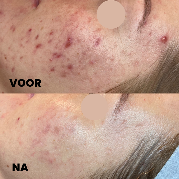 Resultaat van het Acnevrij programma: voor en na